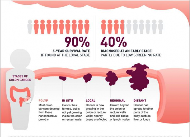 Early simptoms of colon cancer