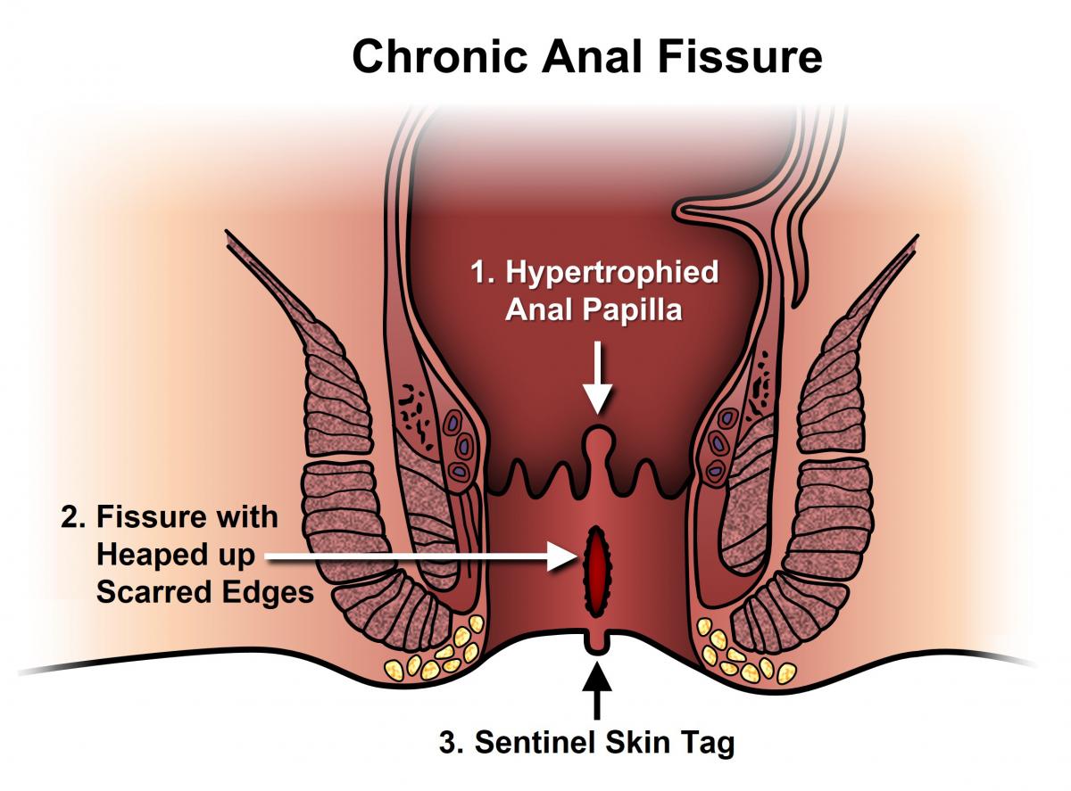 Which therapy for the anal fissure?