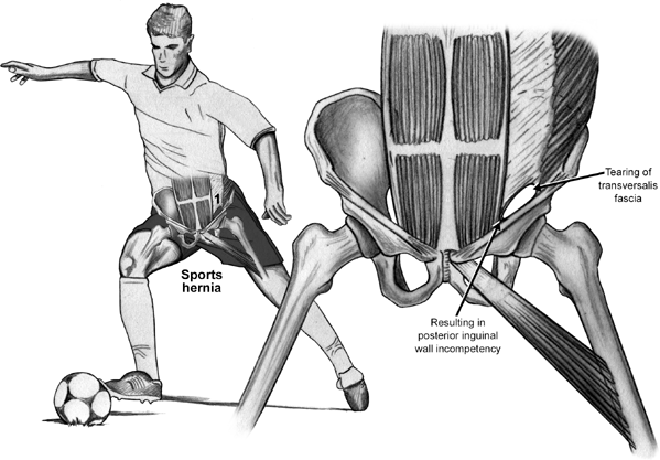 sports-hernia-athletic-pubalgia