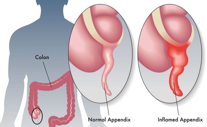 what is the treatment for appendicitis?