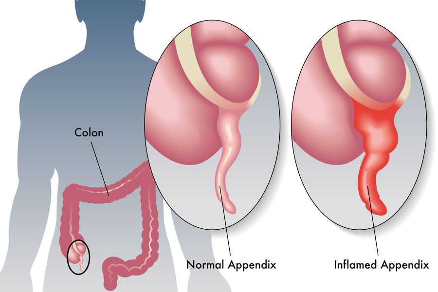 what is the treatment for appendicitis?