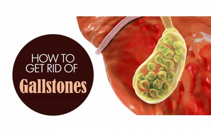 why is gallstone common in women, and at what age is it most likely?