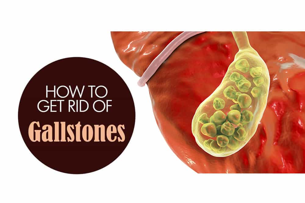why is gallstone common in women, and at what age is it most likely?