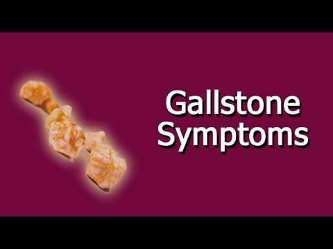 symptoms of gallstone